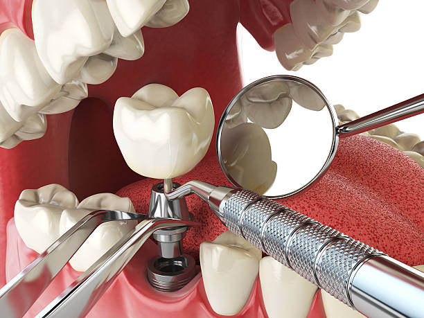 Emergency Dental Filling Replacement in WA